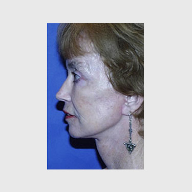 Vertical Facelift Patient 31 After - 3