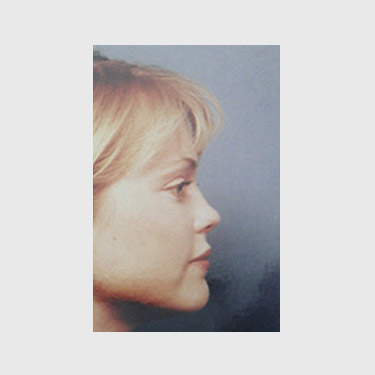 vertical-facelift-patient-32 After