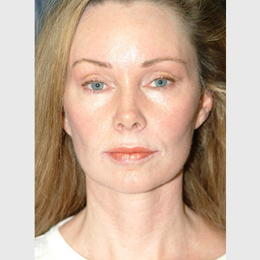 Vertical Facelift Patient 05 After