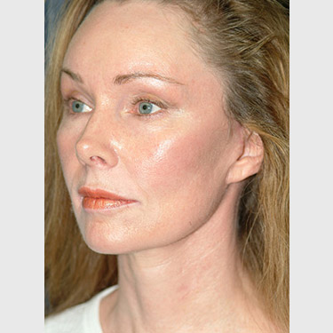 Vertical Facelift Patient 05 After - 2