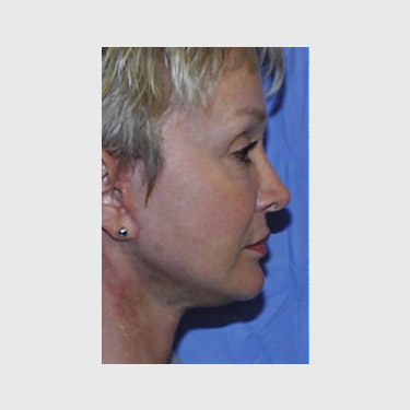 Vertical Facelift Patient 08 After - 2