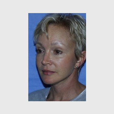 Vertical Facelift Patient 08 After - 3