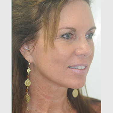 Vertical Facelift Patient 09 After - 2