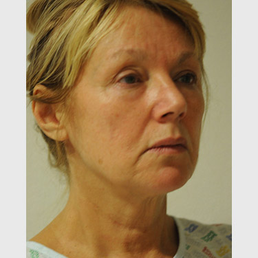 Vertical Facelift Patient 10 Before - 2