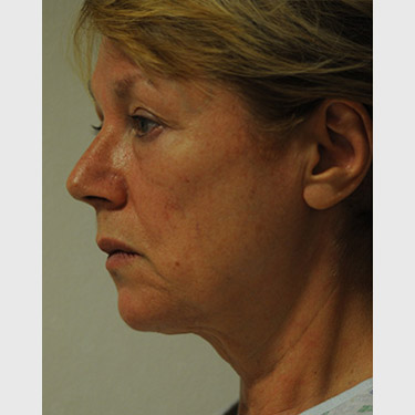 Vertical Facelift Patient 10 Before - 3