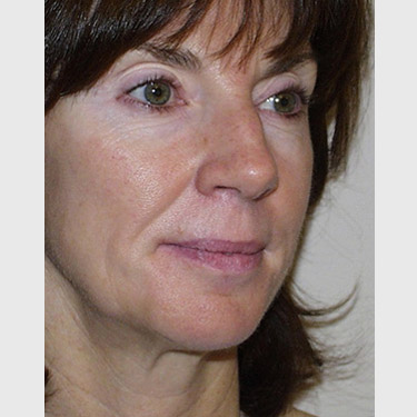 Vertical Facelift Patient 11 Before