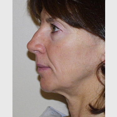 Vertical Facelift Patient 11 Before - 2