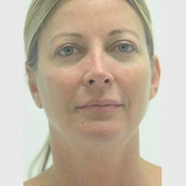 Vertical Facelift Patient 12 Before