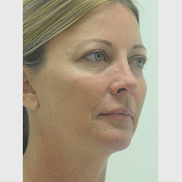 Vertical Facelift Patient 12 Before - 2