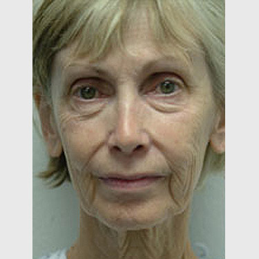 Vertical Facelift Patient 13 Before