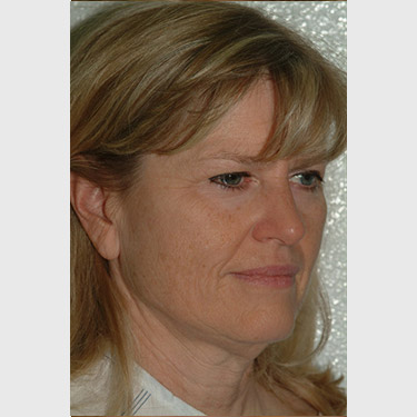 Vertical Facelift Patient 19 Before - 2