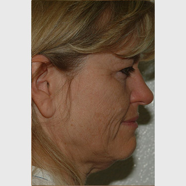 Vertical Facelift Patient 19 Before - 3