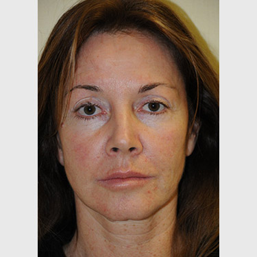 Vertical Facelift Patient 20 Before