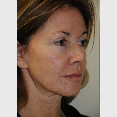 Vertical Facelift Patient 20 Before - 2