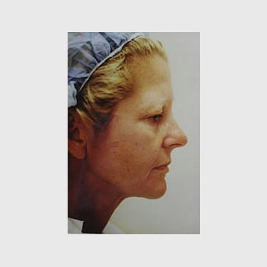 Vertical Facelift Patient 22 Before