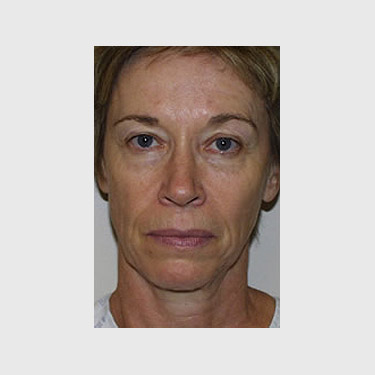 Vertical Facelift Patient 23 Before