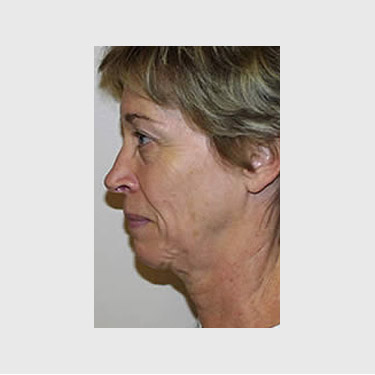 Vertical Facelift Patient 23 Before - 3