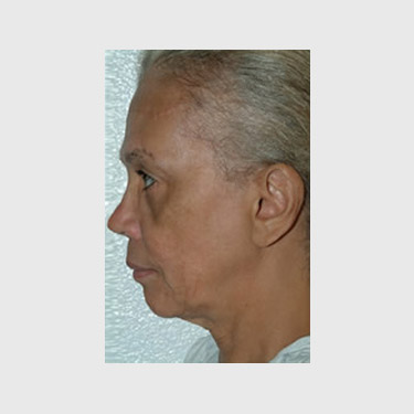 Vertical Facelift Patient 25 Before - 2