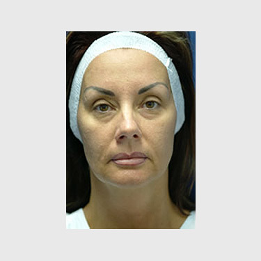 Vertical Facelift Patient 26 Before