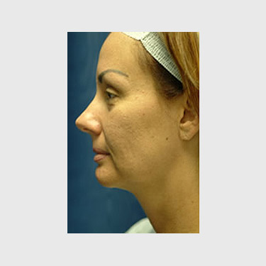 Vertical Facelift Patient 26 Before - 3