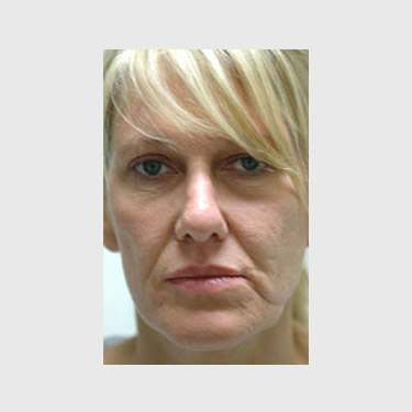 Vertical Facelift Patient 27 Before