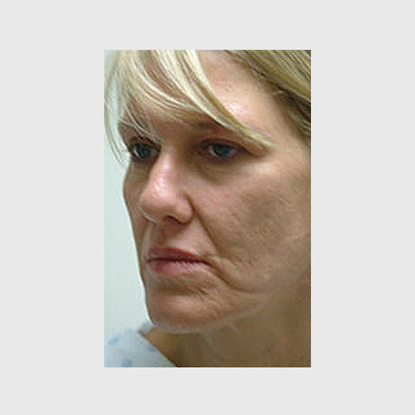 Vertical Facelift Patient 27 Before - 2