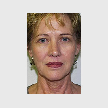 Vertical Facelift Patient 28 Before