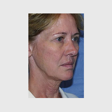 Vertical Facelift Patient 28 Before - 2