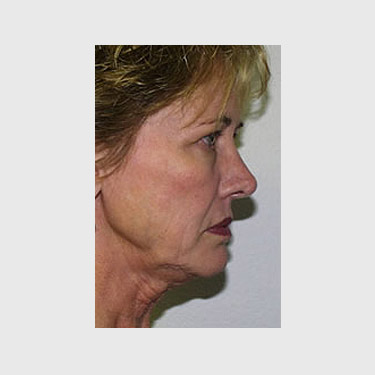 Vertical Facelift Patient 28 Before - 3