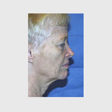 Vertical Facelift Patient 29 Before - 3