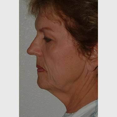 Vertical Facelift Patient 30 Before - 3