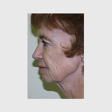 Vertical Facelift Patient 31 Before - 3