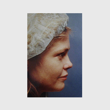 Vertical Facelift Patient 32 Before