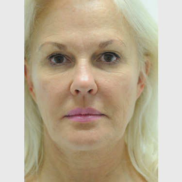 Vertical Facelift Patient 34 Before