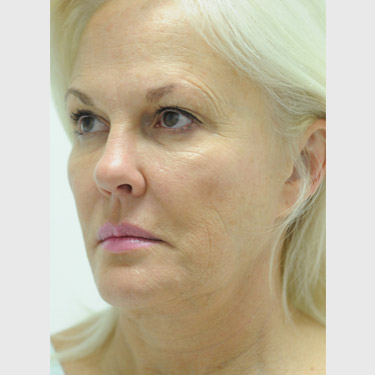 Vertical Facelift Patient 34 Before - 3