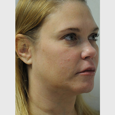 Vertical Facelift Patient 04 Before - 2