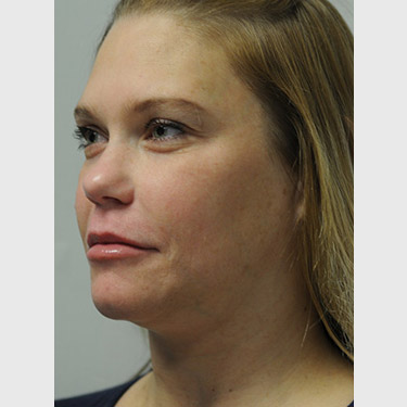 Vertical Facelift Patient 04 Before - 3