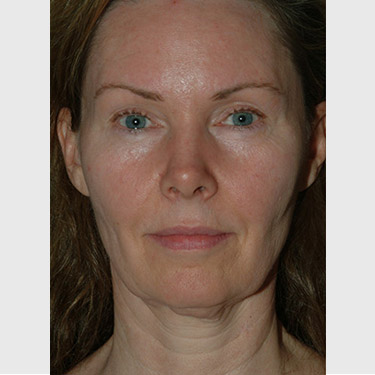 Vertical Facelift Patient 05 Before