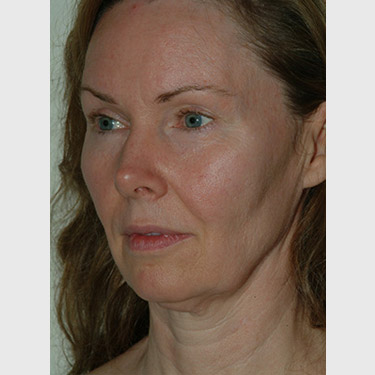 Vertical Facelift Patient 05 Before - 2