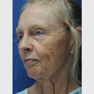 Vertical Facelift Patient 07 Before - 2