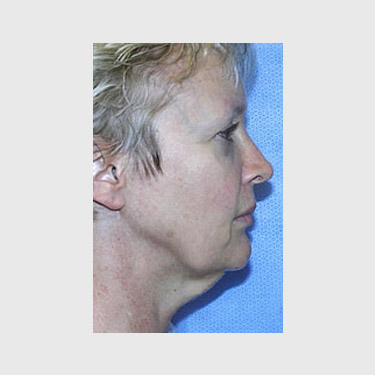 Vertical Facelift Patient 08 Before - 2