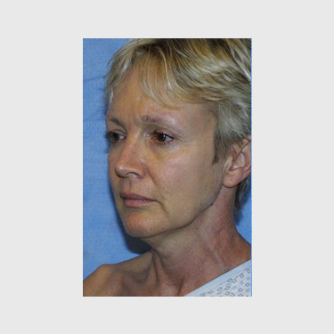 Vertical Facelift Patient 08 Before - 3