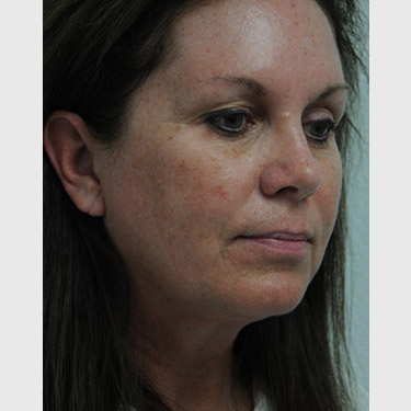 Vertical Facelift Patient 09 Before - 2