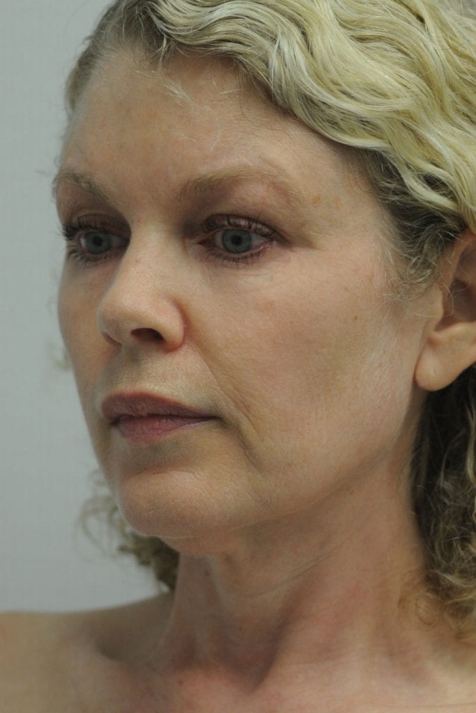 Facelift Patient 01 Before - 3