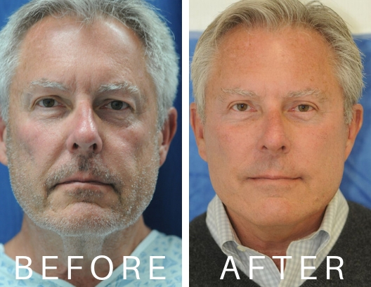 before and after male facelift surgery