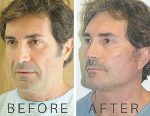 before and after male facelift2