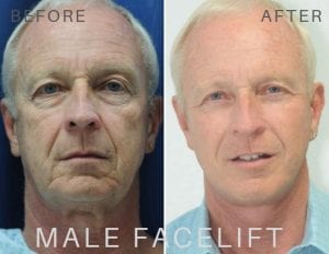 Male Facelift Before and After 