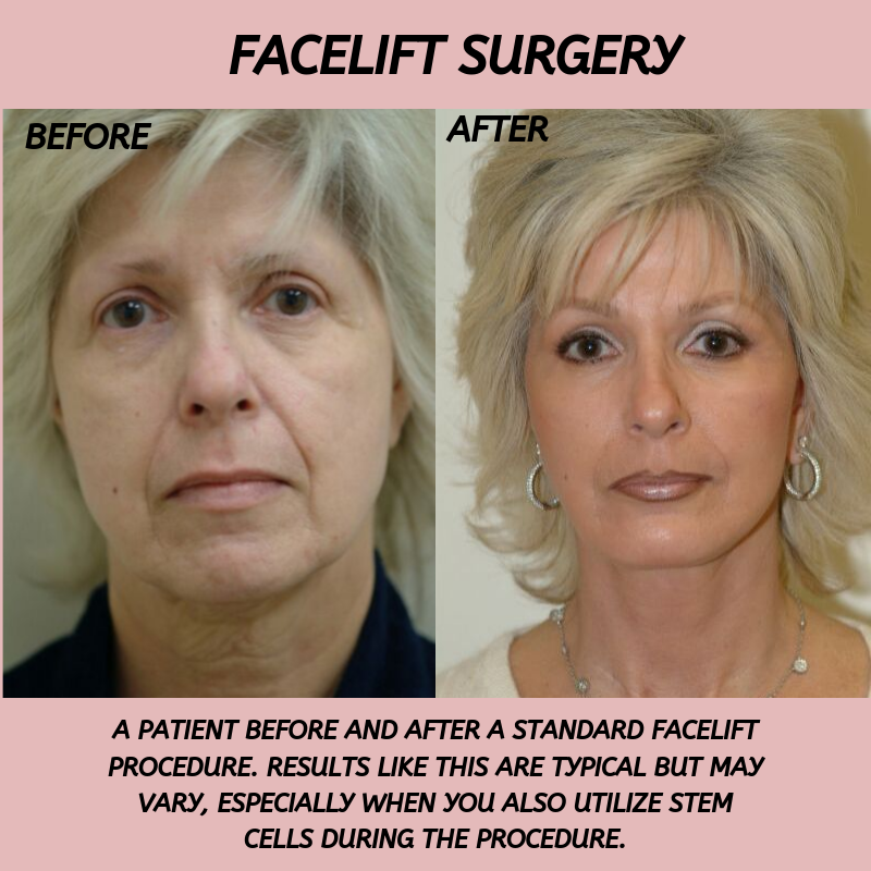 Female Non Surgical Facial