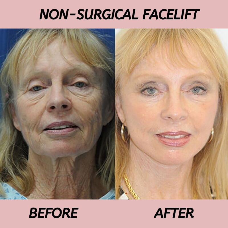 Non Surgical Facelift Before and After