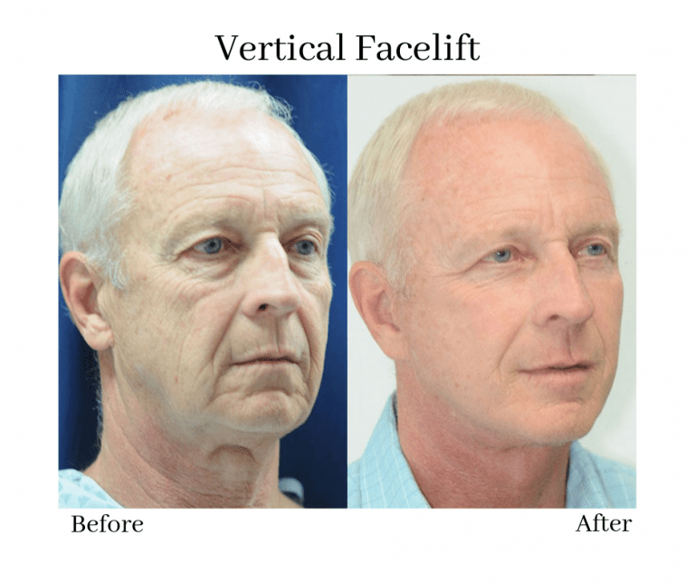 How the Vertical Facelift is Revolutionizing Facial Rejuvenation